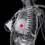 Cancer du sein: l&rsquo;amidon augmenterait le risque de récidive