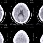 Les acides gras trans associés à la maladie d&rsquo;Alzheimer