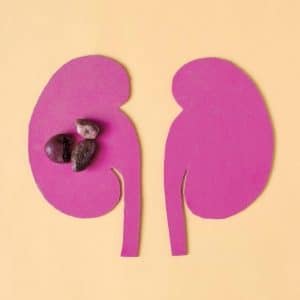 Calculs rénaux: l&rsquo;alimentation a-t-elle une influence?