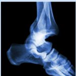 Le calcium ne préviendrait pas les fractures