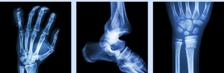 Le calcium ne préviendrait pas les fractures