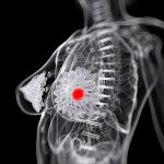 Cancer du sein: l&rsquo;amidon augmenterait le risque de récidive