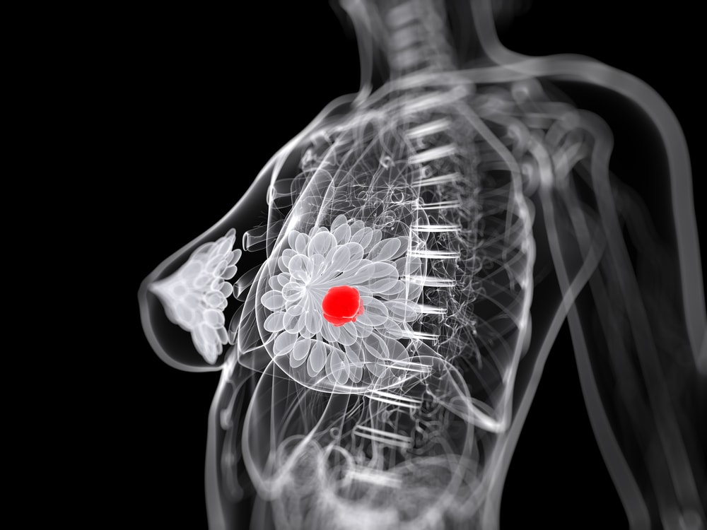 Cancer du sein: l&rsquo;amidon augmenterait le risque de récidive