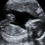 La malnutrition in utero augmenterait le risque de diabète
