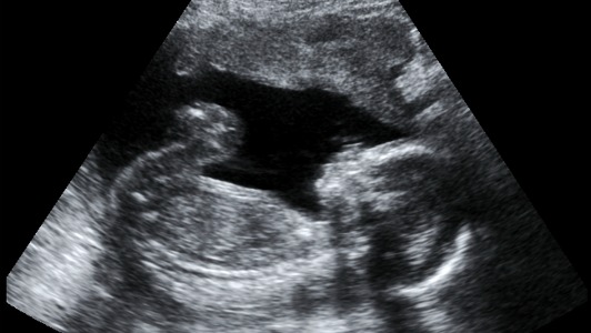 La malnutrition in utero augmenterait le risque de diabète
