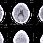 Les acides gras trans associés à la maladie d&rsquo;Alzheimer