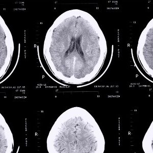 Les acides gras trans associés à la maladie d&rsquo;Alzheimer