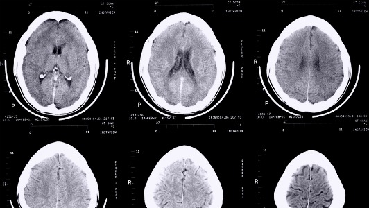 Les acides gras trans associés à la maladie d&rsquo;Alzheimer