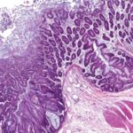 Obésité: la santé dépend du microbiote