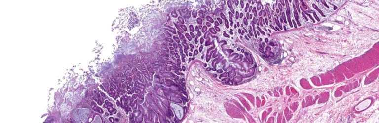 Obesitas: gezondheid hangt af van de microbiota