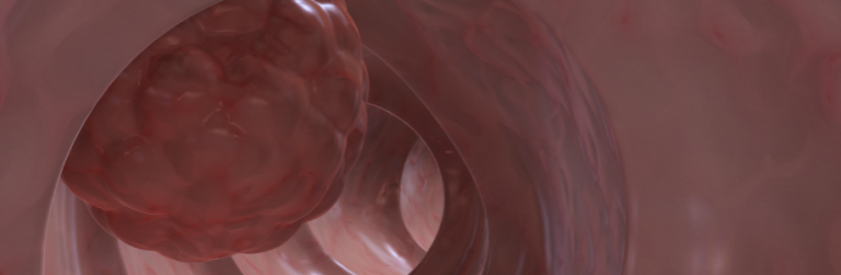 Moins de cas de cancer colorectal chez les végétariens