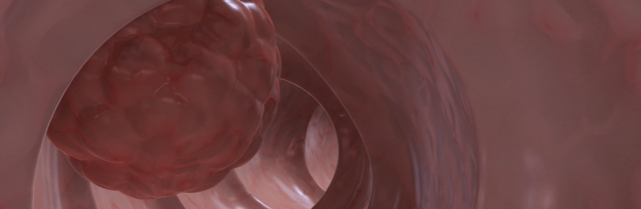 Minder gevallen van dikkedarmkanker bij vegetariërs