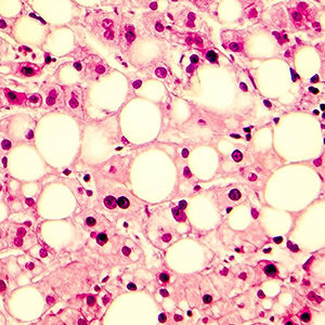 Le microbiote, nouvelle cible pour la stéatose hépatique