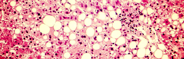 Le microbiote, nouvelle cible pour la stéatose hépatique