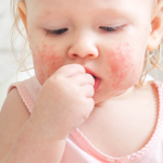 Plus d’allergies alimentaires chez les enfants nés par césarienne