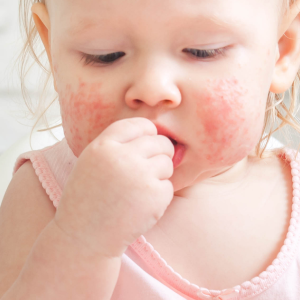 Plus d’allergies alimentaires chez les enfants nés par césarienne