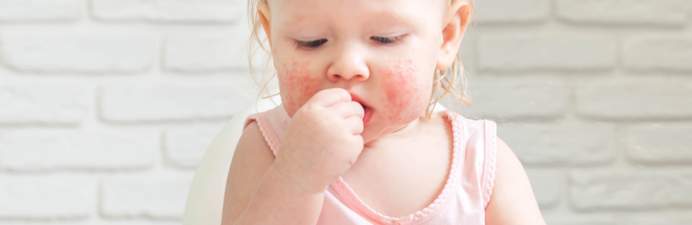 Plus d’allergies alimentaires chez les enfants nés par césarienne